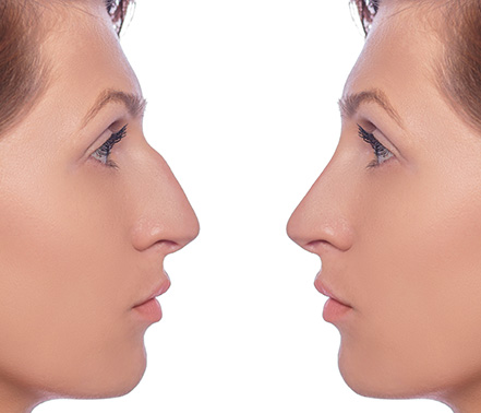 Fracture du nez à Annecy - Chirurgie esthétique/réparatrice visage ...