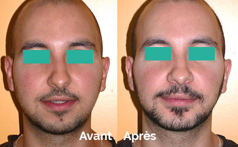 Chirurgie orthognatique / Chirurgie de la machoire Annecy ...